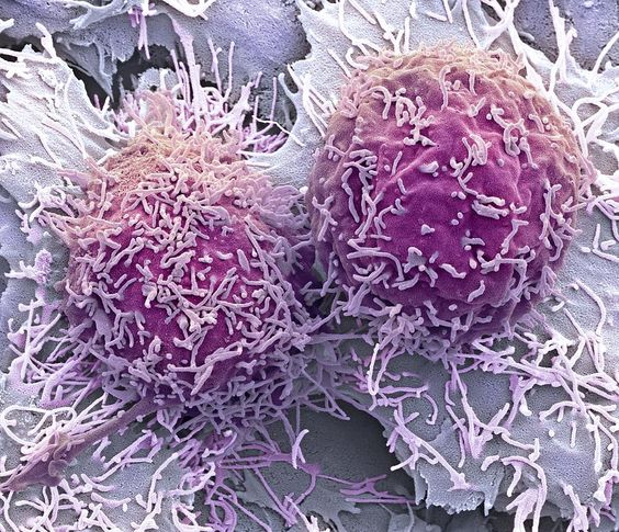 le point faible du cancer _ cellules cancéreuses